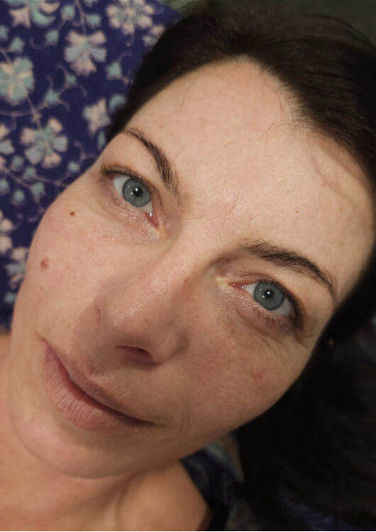 before and after microdermabrasion collagen lift iconic