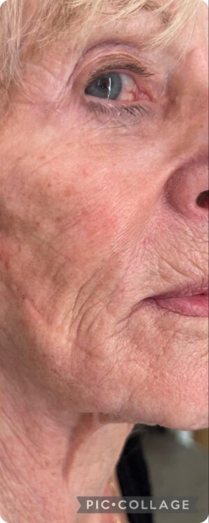 before and after collagen lift IE Beauty and Aesthetics