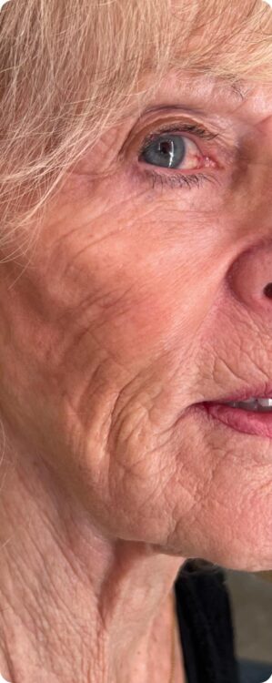 before and after collagen lift IE Beauty and Aesthetics