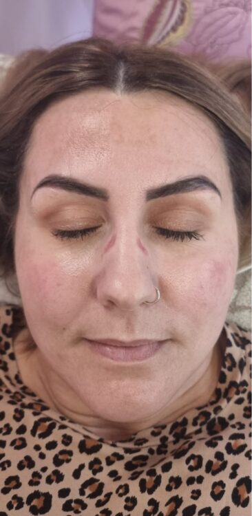 before and after microdermabrasion Hollywood beauty