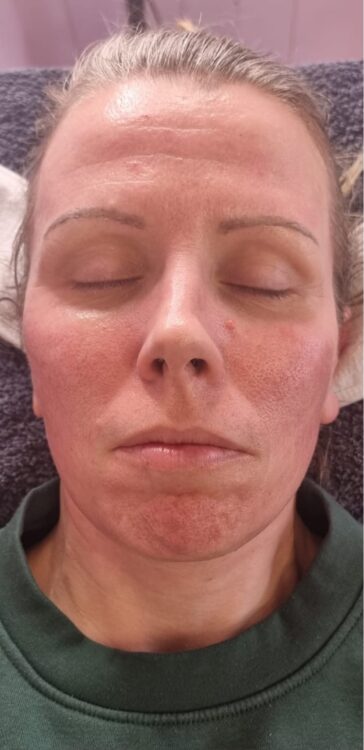 before and after collagen lift Hollywood beauty