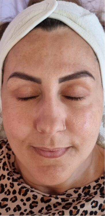 before and after microdermabrasion Hollywood beauty