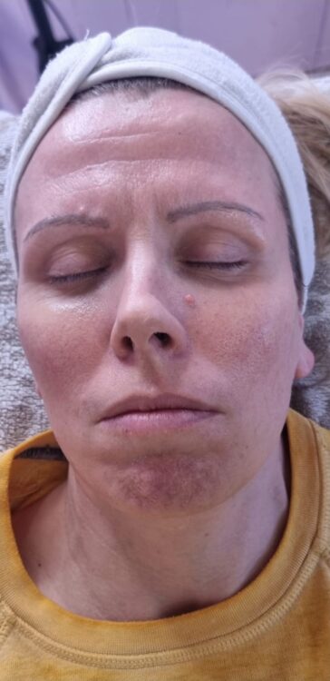before and after collagen lift Hollywood beauty