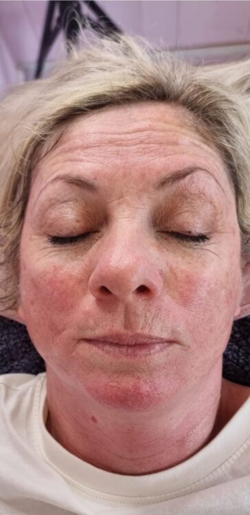 before and after collagen lift Hollywood beauty