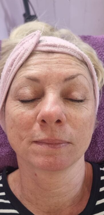before and after collagen lift Hollywood beauty