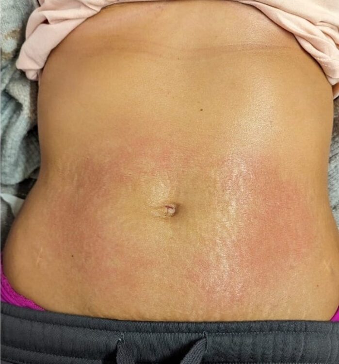 before and after collagen lift Hollywood beauty