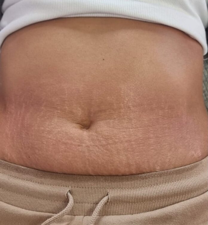 before and after collagen lift Hollywood beauty