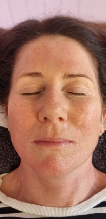 before and after collagen lift ultimate Hollywood beauty