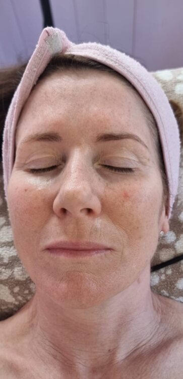 before and after collagen lift ultimate Hollywood beauty
