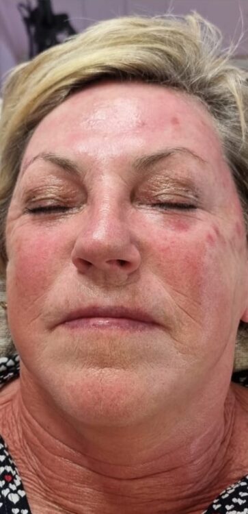 before and after collagen lift glam salon academy
