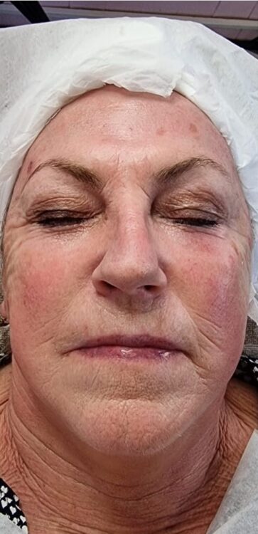 before and after collagen lift glam salon academy