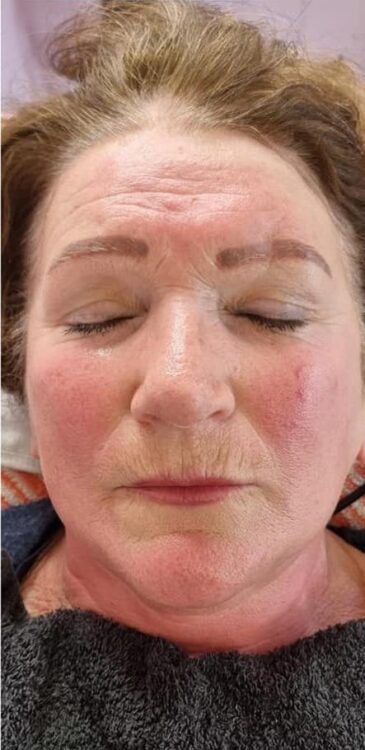 before and after collagen lift Hollywood beauty