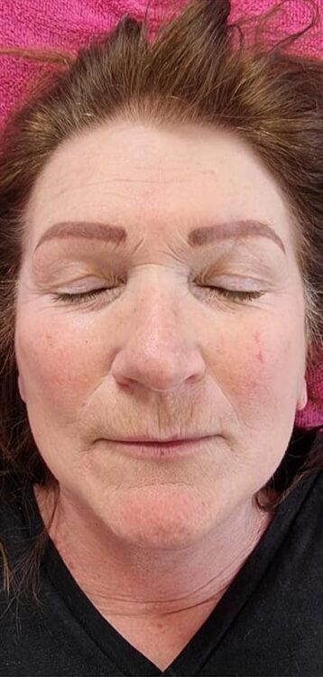 before and after collagen lift Hollywood beauty