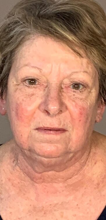 before and after collagen lift jo Hannan skin health and transformations