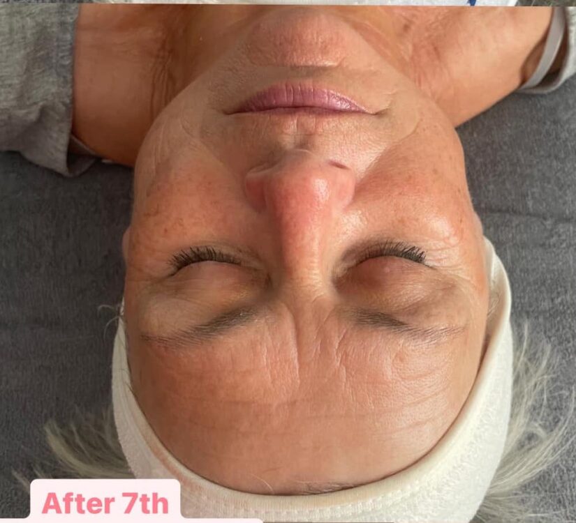 before and after microdermabrasion Karen's home hairdressing
