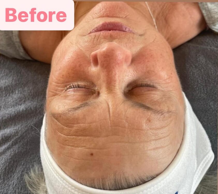 before and after microdermabrasion Karen's home hairdressing