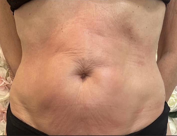 before and after collagen lift Katherine Monique Beauty