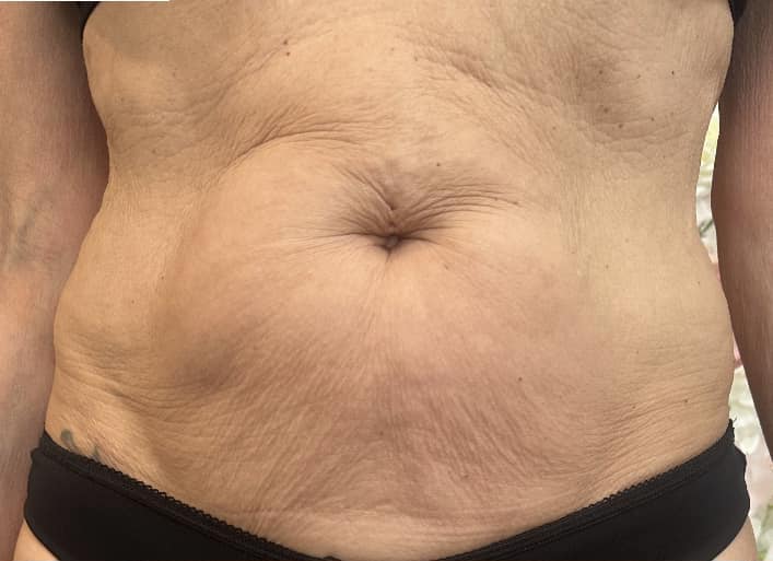 before and after collagen lift Katherine Monique Beauty