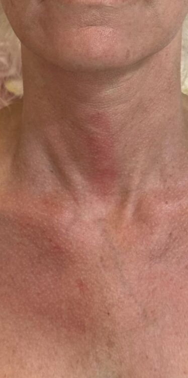 before and after collagen lift Katherine Monique Beauty