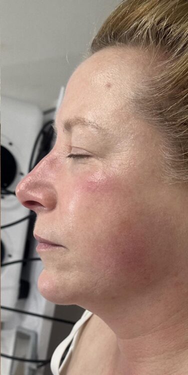 before and after collagen lift Katherine Monique Beauty