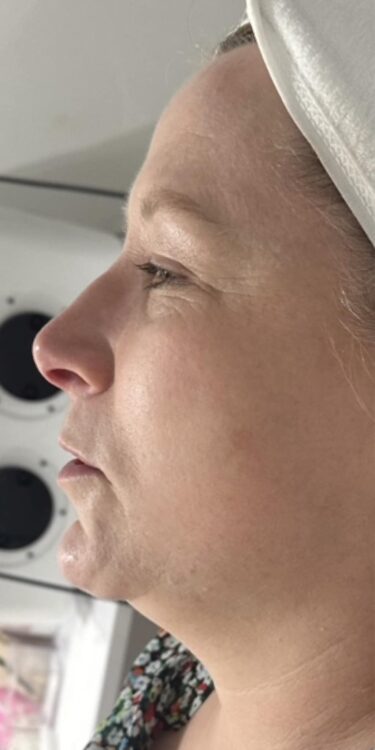 before and after collagen lift Katherine Monique Beauty