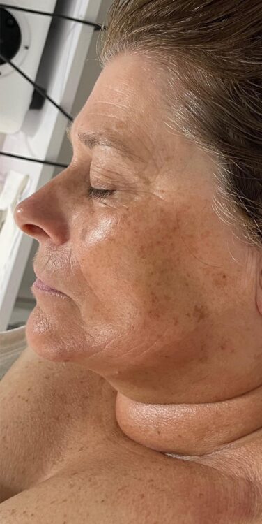 before and after collagen lift Katherine Monique beauty