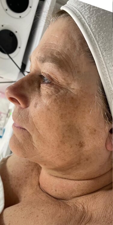 before and after collagen lift Katherine Monique beauty