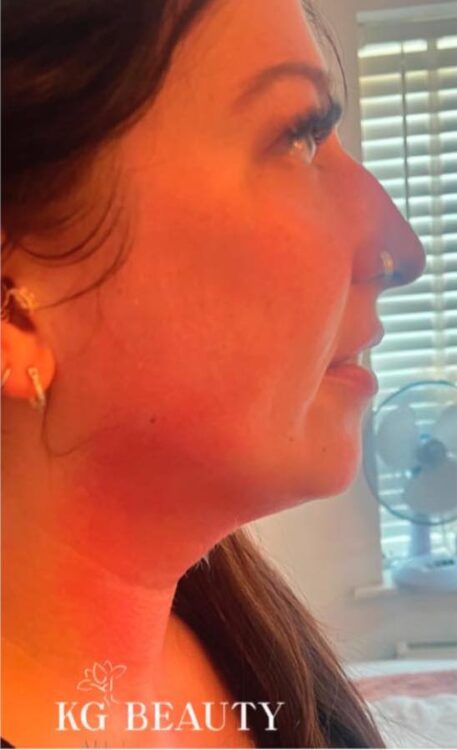 before and after collagen lift kg beauty and aesthetics