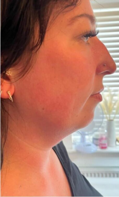 before and after collagen lift kg beauty and aesthetics