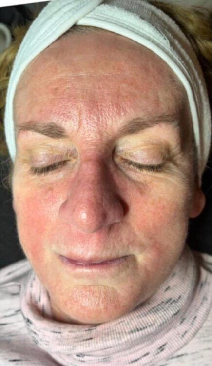 before and after collagen lift kg beauty and aesthetics