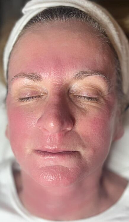 before and after collagen lift kg beauty and aesthetics