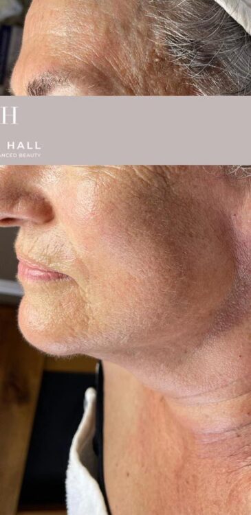 before and after collagen lift