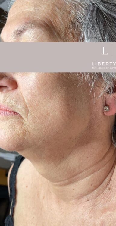 before and after collagen lift
