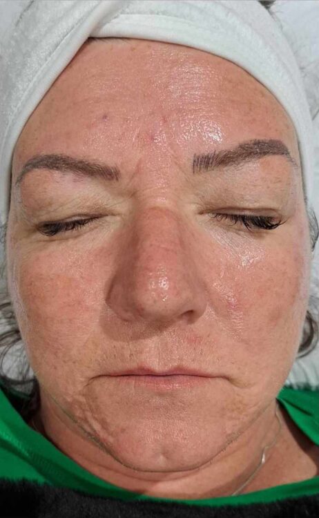 before and after microdermabrasion LJ studios