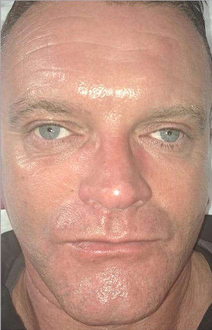 before and after microdermabrasion LJ Studios