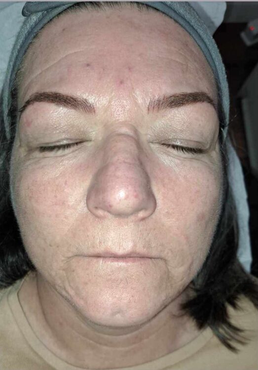 before and after microdermabrasion LJ studios