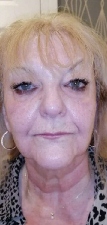 before and after collagen lift looks well beauty salon