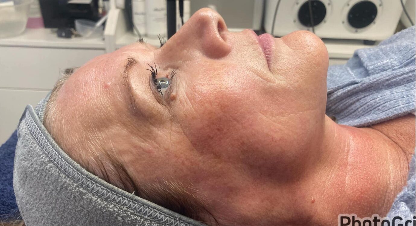 before and after collagen lift Lynne's beauty