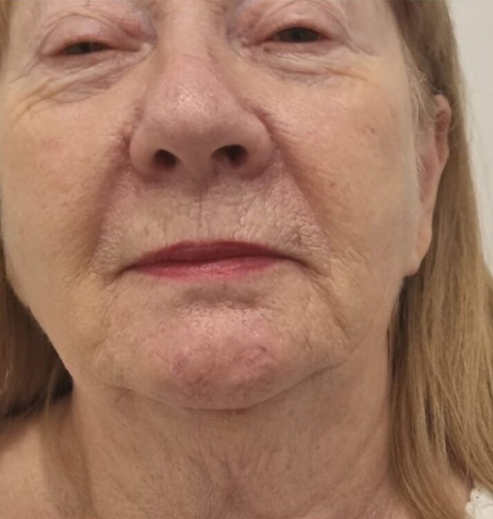 before and after collagen lift inspirations