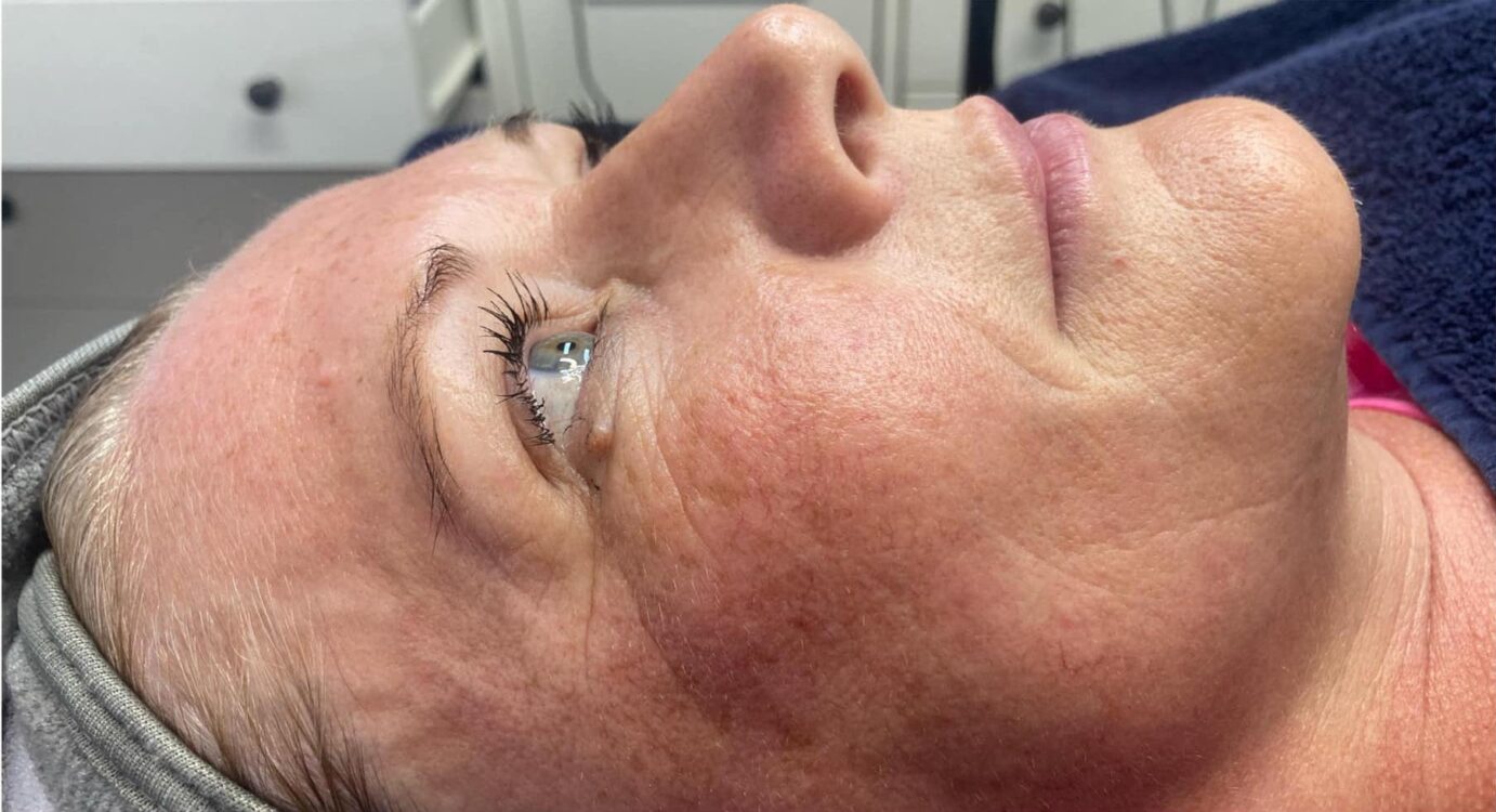 before and after collagen lift Lynne's beauty