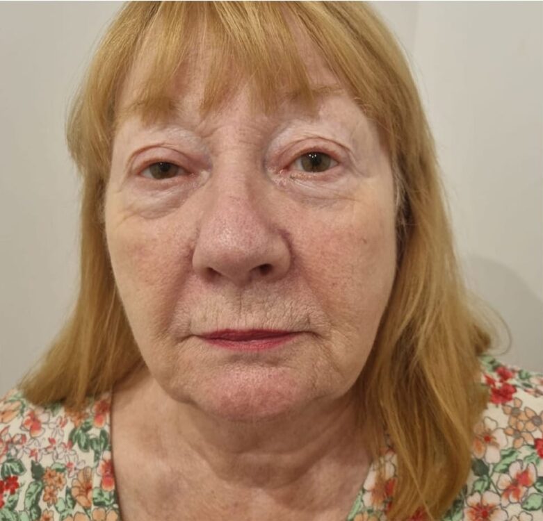 before and after collagen lift inspirations