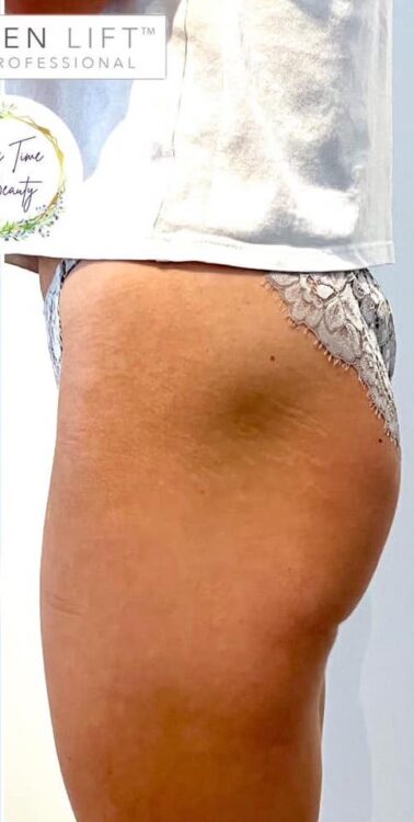before and after collagen lift me time beauty
