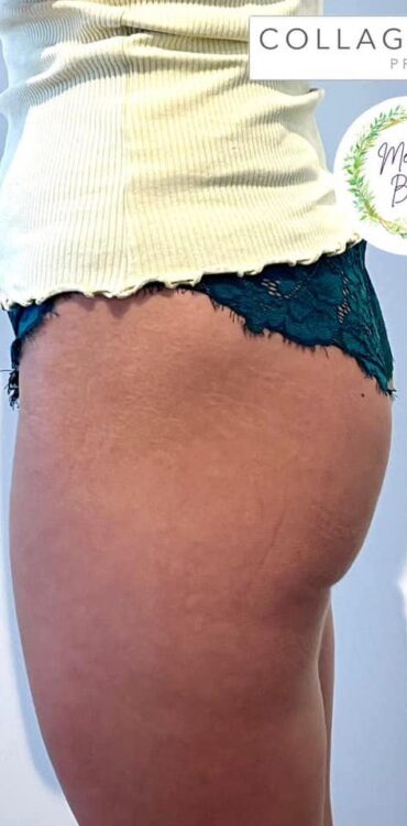 before and after collagen lift me time beauty