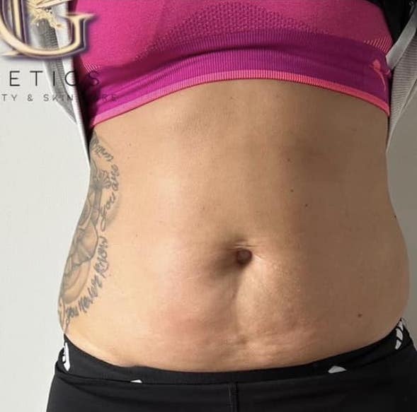 before and after collagen lift mg aesthetics