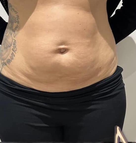 before and after collagen lift mg aesthetics