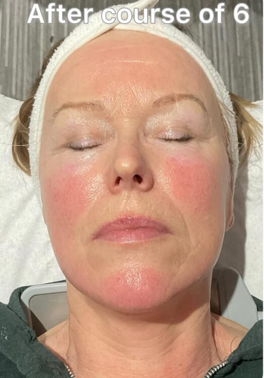 before and after collagen lift moorlands beauty skin centre