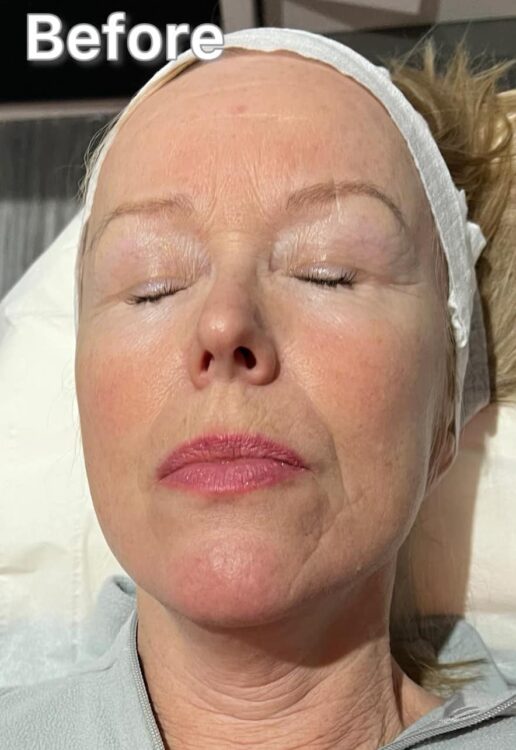 before and after collagen lift moorlands beauty skin centre