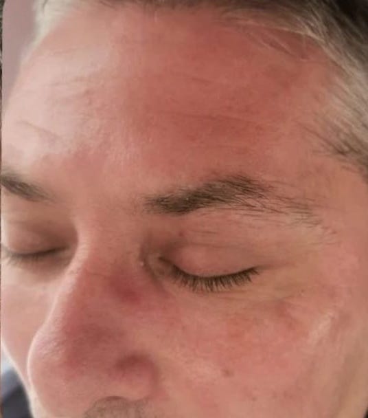 before and after microdermabrasion nails by Kelly Anne