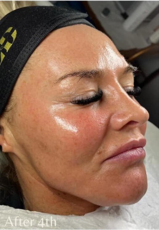 before and after microdermabrasion naked skin clinic