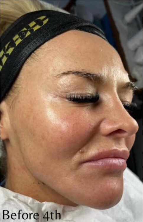before and after microdermabrasion naked skin clinic